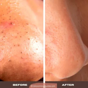 Blackhead - Before and After