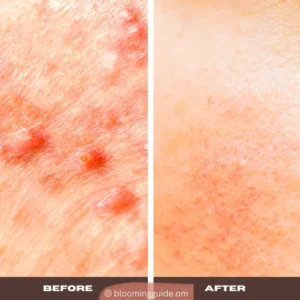 Inflamed Acne, Hormonal Acne and Cystic Acne - Before and After